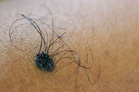 Hairy moles may provide antidote for baldness, UCI researchers find